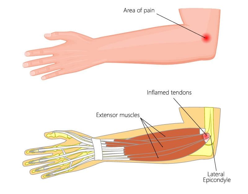 How To Treat Tennis Elbow At Home 4 lateral epicondylitis