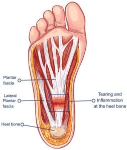 Plantar Fasciitis Anatomy Heel