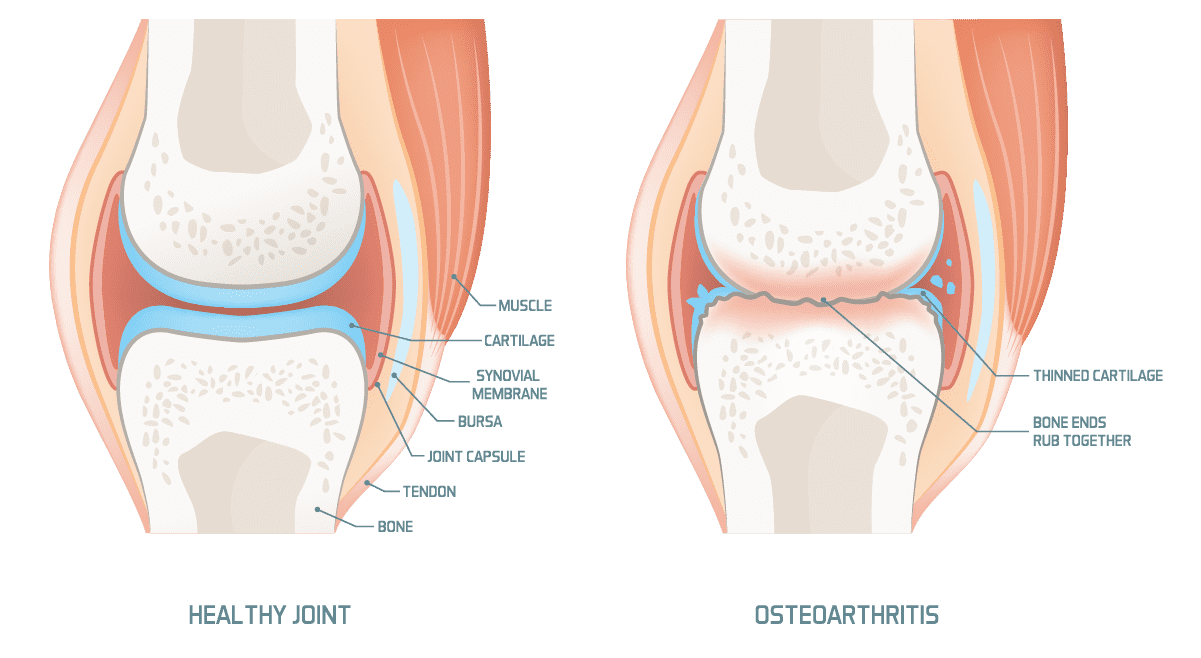 Arthritis Of the Knee 1 Arthritis Of The Knee