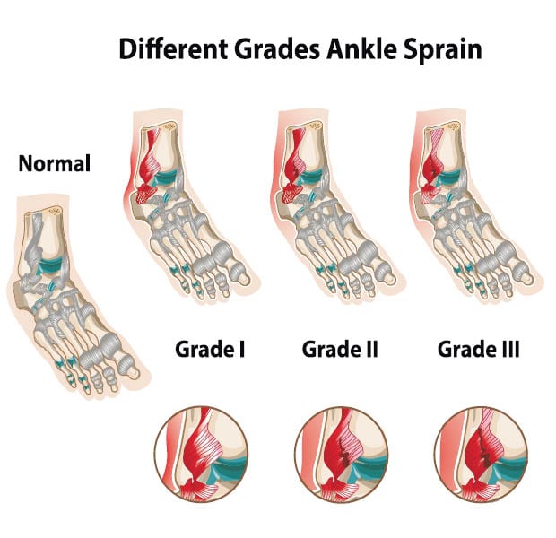 Ankle Sprain Grades