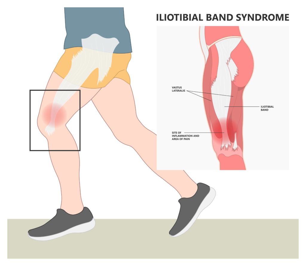 IT Band Syndrome Graphic