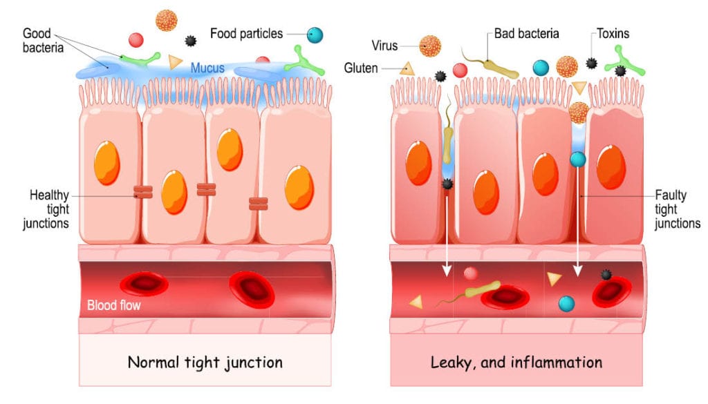Leaky gut