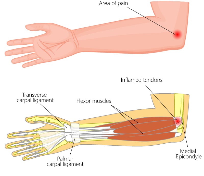 Medial Epicondylitis Elbow Pain