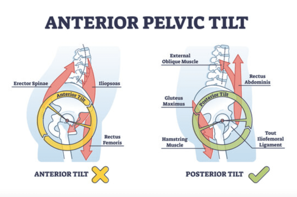 anterior pelvic tilt
