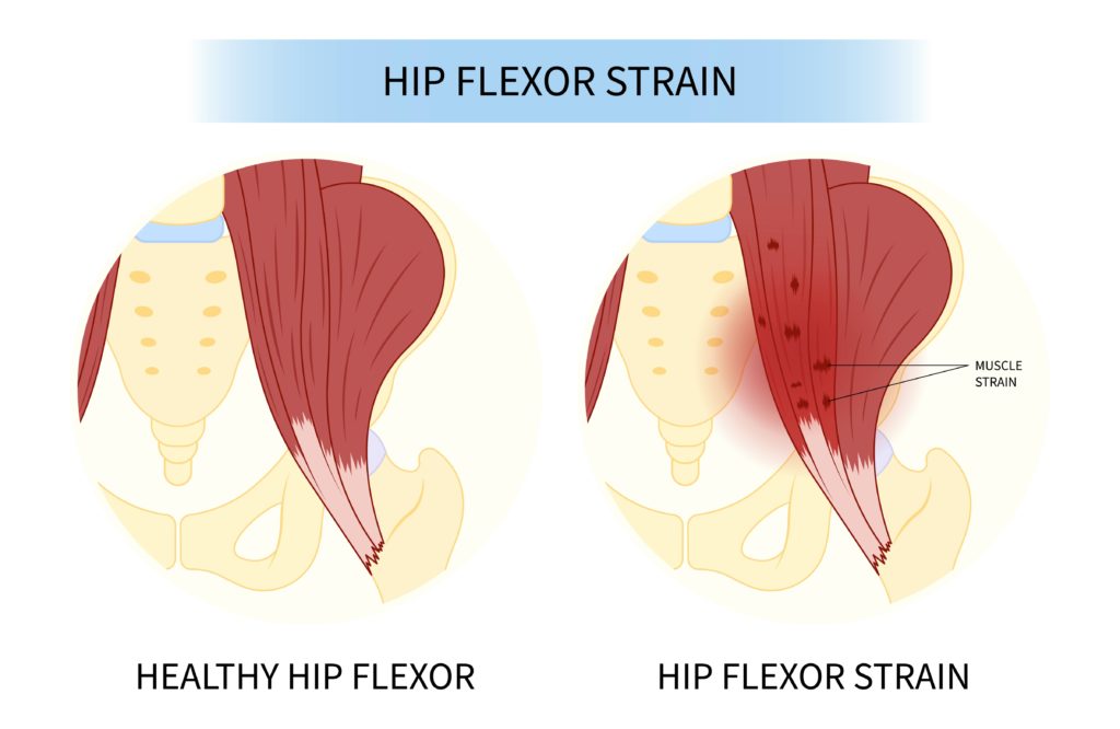 hip flexor strain anatomy image
