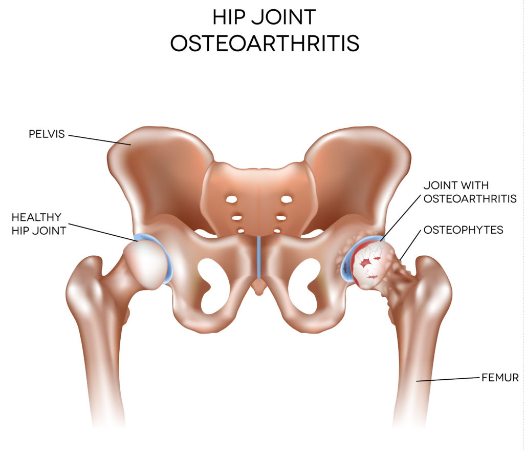 hip joint osteoarthritis illustration