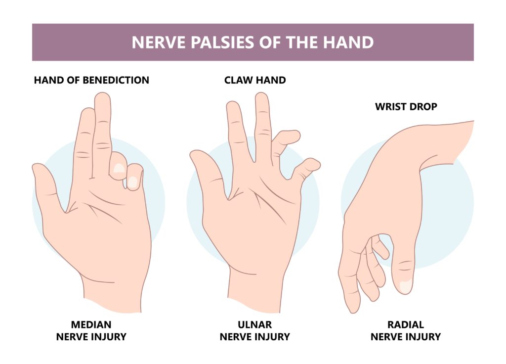 Pronator teres syndrome