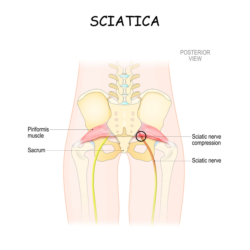Sciatica posterior view illustration diagram