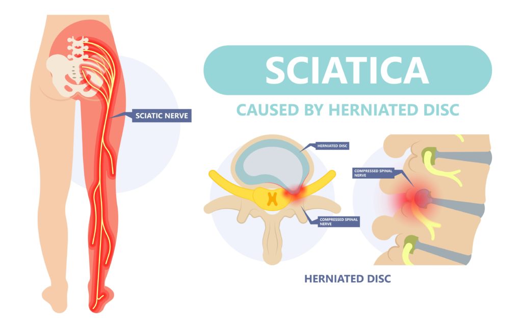 Sciatica from herniated disc illustration