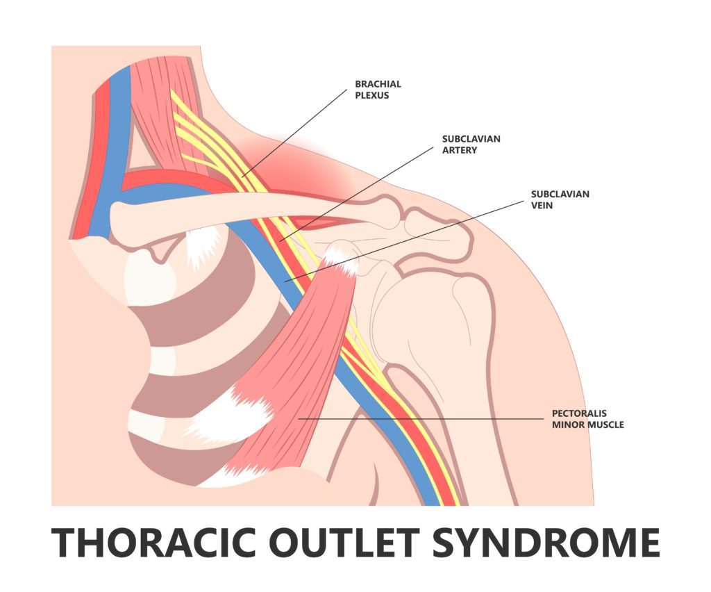 Thoracic outlet syndrome
